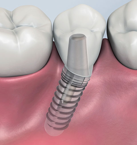 Ein im Kiefer verschraubtes Implantat